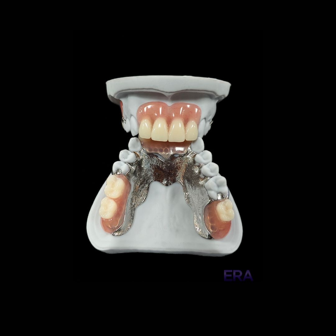 EraDentalLab's tweet image. Cr-co Metal Framework with Acrylic Partial Complete #DentalLab #DentalLabTech #DentalProsthetics #DentalImplants #Dentistry 

©ERA Dental Lab. All Rights Reserved.
Unauthorized use or reproduction of our work is strictly prohibited. Do not copy or repost without permission.
