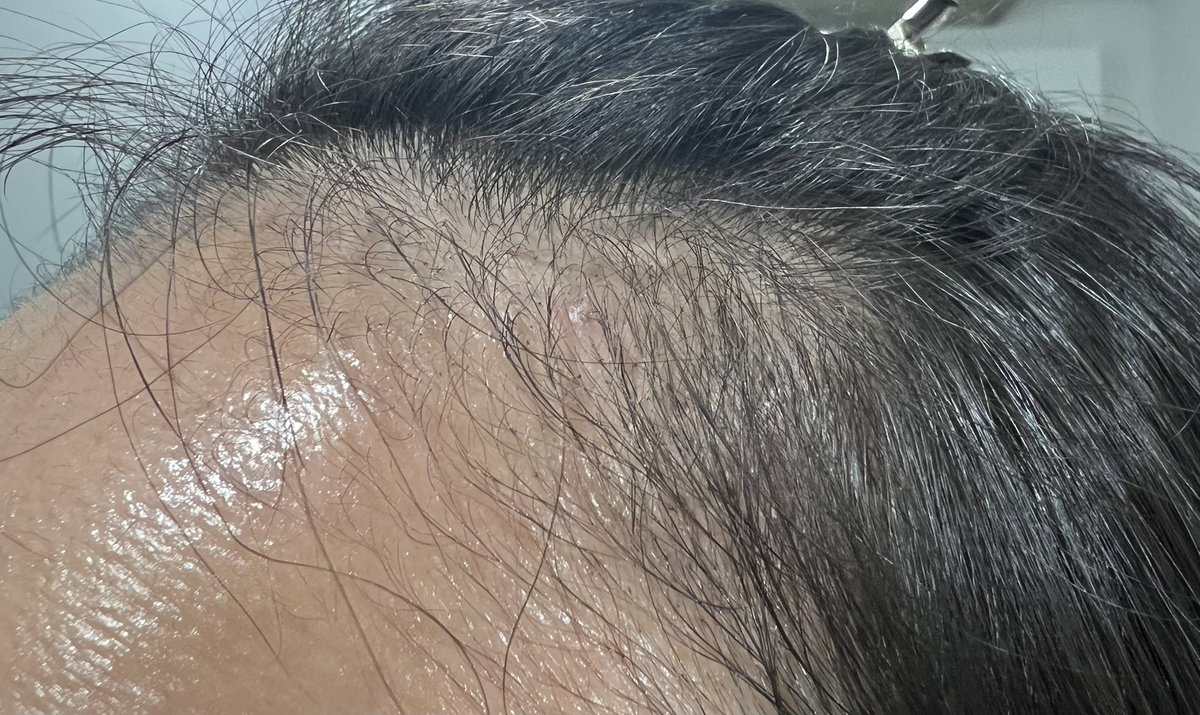 FbYh9i's tweet photo. 【ヘアライン植毛2ヶ月】
体感ほぼ抜けた！暗黒期！！ハゲ過ぎて草！！！
1ヶ月超えたあたりで急にほぼ抜けて虚無状態、大丈夫かこれ...
産毛が生えてるから生えても分かりづらそうだし生えたとしてもしばらく実感できないのかな...チリ毛でいいから早く生えておくれ... https://t.co/nnNbnlD0Ab
