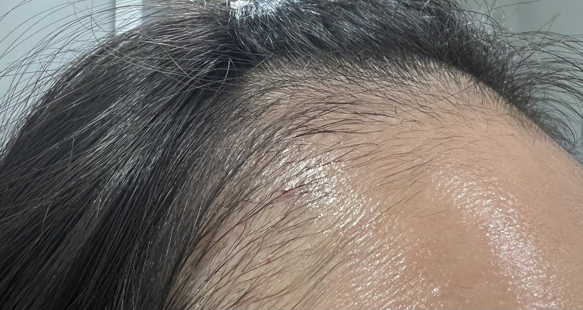 FbYh9i's tweet photo. 【ヘアライン植毛2ヶ月】
体感ほぼ抜けた！暗黒期！！ハゲ過ぎて草！！！
1ヶ月超えたあたりで急にほぼ抜けて虚無状態、大丈夫かこれ...
産毛が生えてるから生えても分かりづらそうだし生えたとしてもしばらく実感できないのかな...チリ毛でいいから早く生えておくれ... https://t.co/nnNbnlD0Ab