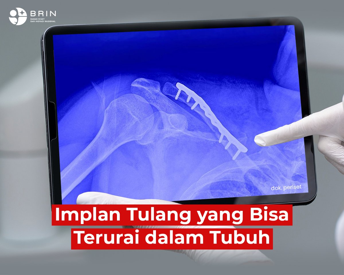 brin_indonesia's tweet image. Pemenang L'ORÉAL–UNESCO For Women in Science 2025 siap jadi inovasi masalah implan tulang!

#implan #tulang #magnesium #BRIN #RisetInovasi