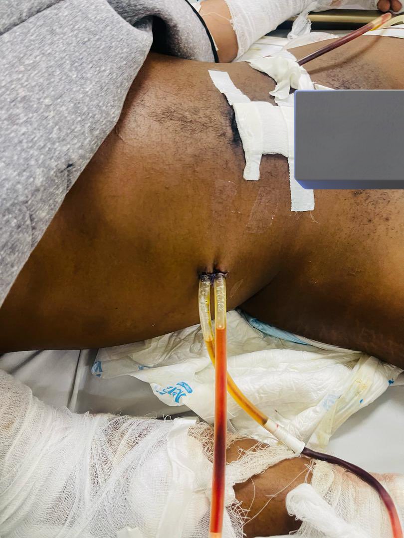 faridaah_xx's tweet image. Assalamu Alaikum warahmatullahi wabarakatuh!

My brother is dying &amp;amp; needs URGENT surgery NOW! We’ve only raised ₦3.35M of ₦16M needed.

Nigerians, please I’m begging on my knees kindly please donate any amount for Allah’s sake to save his life!

Jazakallahu khairan