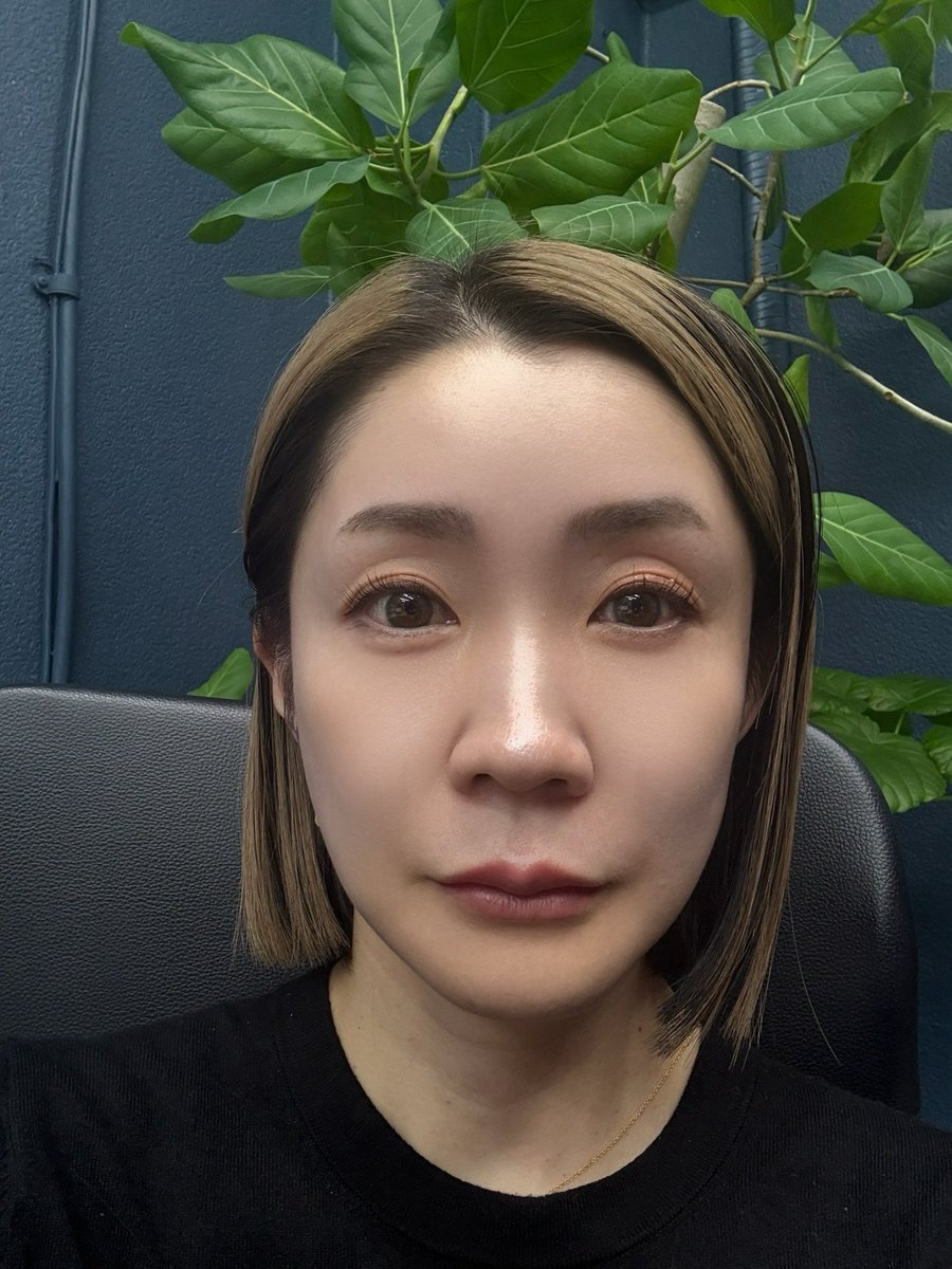 yoshie_onni's tweet photo. 【閲覧注意？】輪郭3点のダウンタイム、本音で語ります

きれいになった今だから言えること
術後は想像以上にきつかった😭

《術後の経過リアル》

🔴 当日（手術8時間）
・麻酔から覚めた瞬間、喉の激痛
・「やらなきゃよかった」と本気で思った
・口が開けられず、スマホで会話
・座ったまま寝る辛さ

🟡 術後2-3日（腫れピーク）
・顔がパンパンで別人
・ゲストハウスで孤独な戦い
・処方薬とアイスパックが命綱
・「本当に元に戻る？」不安MAX

🟢 術後3-7日（少し回復）
・外を歩けるようになった
・DA美容外科でアフターケア
・高圧酸素カプセル、腫れケアレーザー
・日本語スタッフに救われた

🔵 術後10日（帰国）
・まだ腫れあり、でも希望が見えた
・帰国後も経過観察は続く

でも今、4ヶ月経って思う
あの辛さは全部価値があった✨

フェイスラインがシャープになって
鏡を見るのが楽しい

《これから受ける人へ》
✅ ダウンタイムは甘く見ちゃダメ
✅ 10日は渡韓期間確保して
✅ アフターケア充実の病院選びが重要
✅ 孤独対策（配信、散歩）も大事

DA美容外科はアフターケアが本当に充実
だから安心して乗り越えられた🙏

輪郭整形、興味あるけど不安…
そんな方はDMで「ダウンタイム相談」と送ってください💌

リアルな話、全部お伝えします