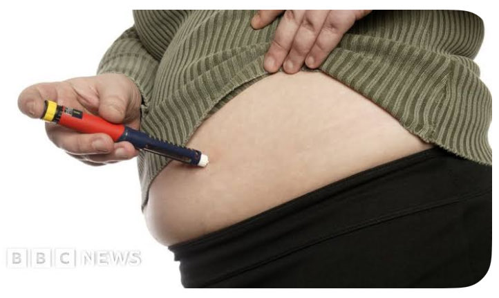 مواطن اقل من ٢٠ سنه ، طول ووزن تقريبا 170/125 كتلة جسم 44 ، يادكتور ودي انحف ومابي جراحه ابغى اجرب مونجارو 

اجرينا تحاليل مبدأيه طلع فجأه السكر التراكمي عنده 13 ‼️( الطبيعي اقل من 6 ) رسميا الان مريض سكري وهو لايعلم 

تم تحويله للزملاء استشاري السكري وقالوا له اما تنحف او راح