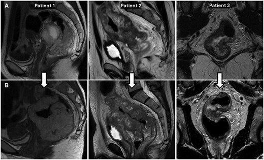 OncJournal's tweet photo. Although #dostarlimab yields high responses in #dMMR LARC this paper reports 3️⃣ cases w/ progression on #IO; all #MSIHigh w/ high #TMB. #Transcriptomics showed #stromal-high profiles linked to worse #ICI response.
@susanebates  @gbanna74  @PasRescigno 
https://t.co/0sbE8k1s7j https://t.co/XIl0DFbPqw