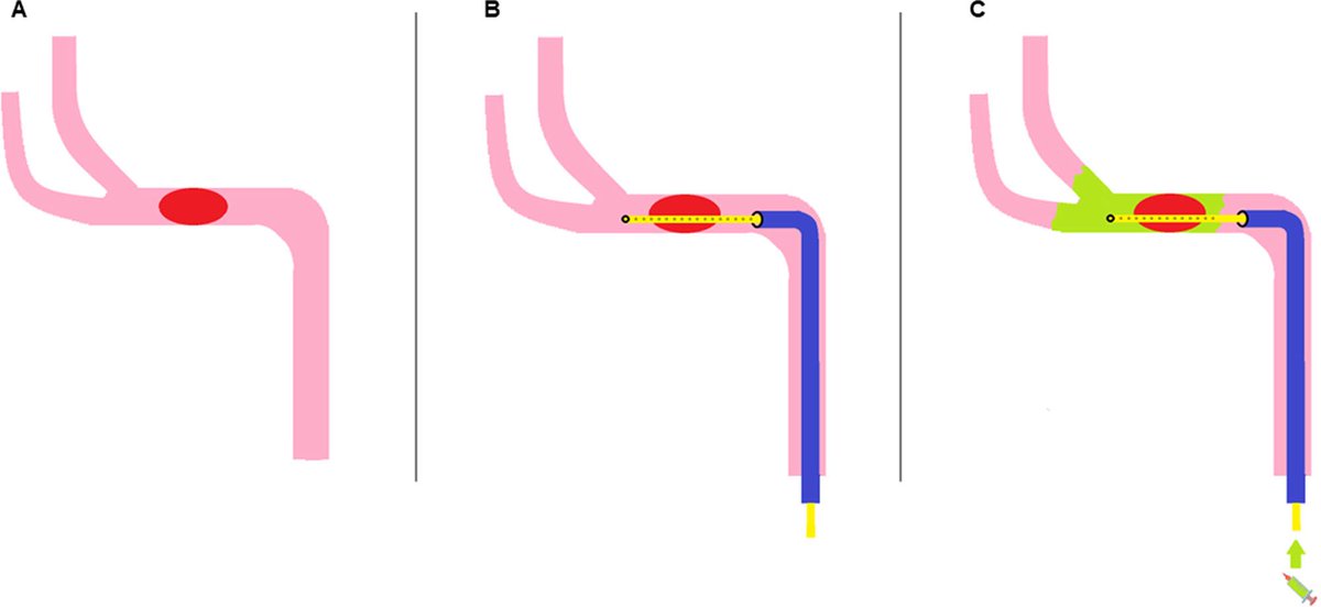 AshuPJadhav's tweet photo. Efficacy Assessment of the TIMSO Microcatheter for Endovascular Thrombectomy in the Treatment of Acute Ischemic Stroke | Stroke: Vascular and Interventional Neurology https://t.co/2tNNLSNV2H @StrokeAHA_ASA @SVINJournal @SVINJournal https://t.co/IaB1L0edZF