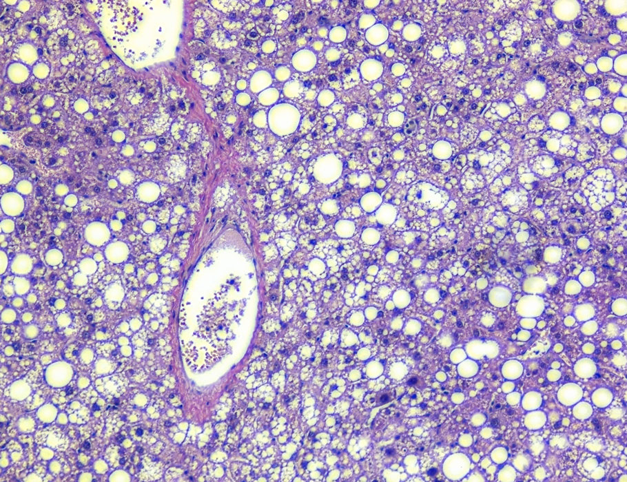 scisignal's tweet image. Researchers identify protein SCoR2 as a potential drug target for #obesity, hepatic #steatosis in studies of mice, showing that it prevents fat accumulation and weight gain. scim.ag/4qkgiTT @cwru