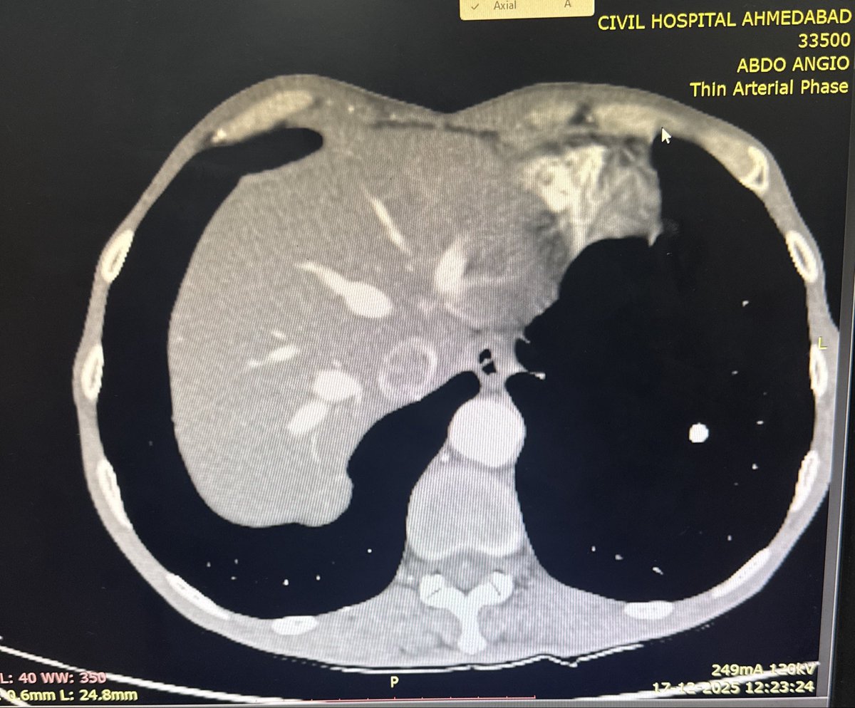 _rutvik_patel's tweet photo. What could be the possible causes of contrast in the hepatic veins during the arterial phase of a CECT abdomen?

#MedX
#Radiology 
#RadX https://t.co/Jdo91774JN