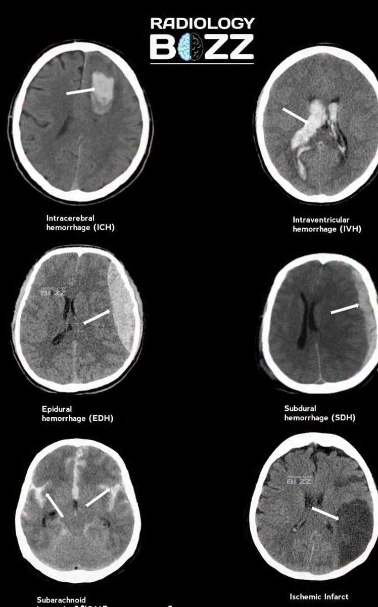 OGdukeneurosurg's tweet photo. CT findings BRAIN tips https://t.co/lzhP8SQdmK