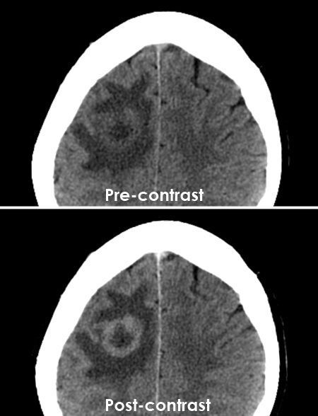 RadMasterclass's tweet photo. CT BRAIN 26: Headaches, clumsiness, seizure, normal inflammatory markers. What is the differential diagnosis? Answer https://t.co/Hb30D9p0Gw https://t.co/RN44fjXarn