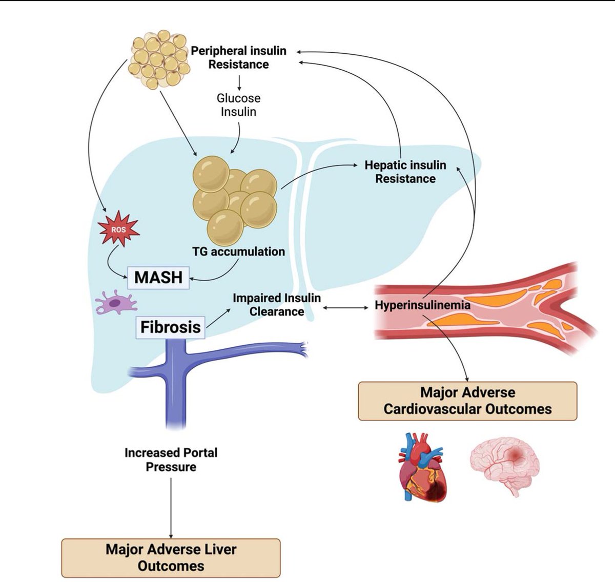 Liver fibrosis + hyperinsulinemia are central drivers of bad outcomes in MASLD/MASH. The MASLD pathway → liver fibrosis + impaired hepatic insulin clearance → worsening insulin resistance + hyperinsulinemia (an independent predictor of MACE). Liver fibrosis also ↑ portal