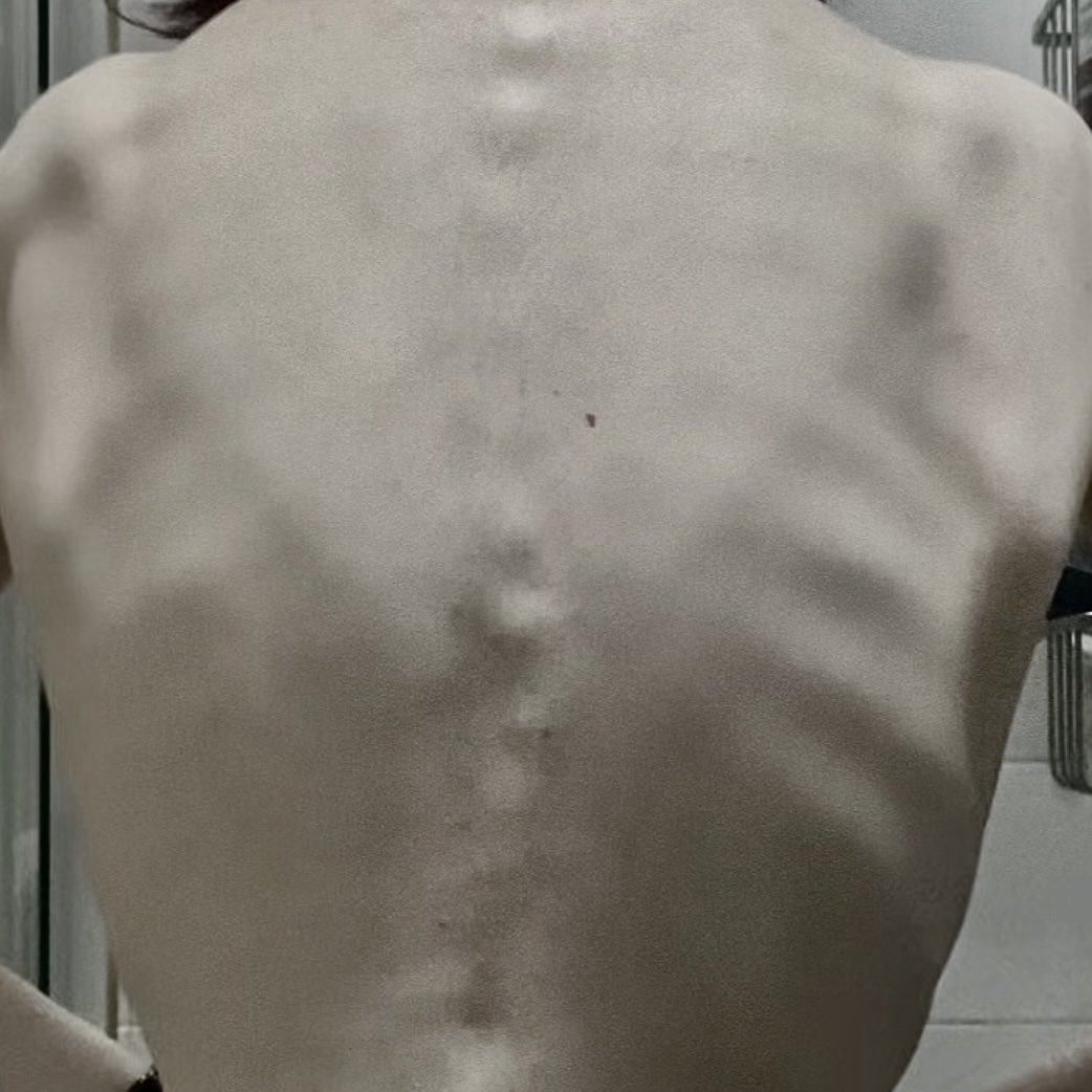 implicitcrulety's tweet image. It's me and my scoliosis against the world