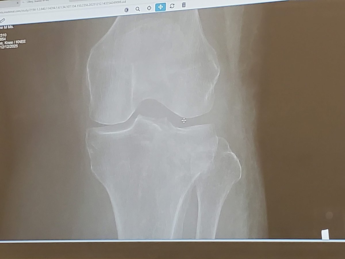 At least 5 more weeks of non weight bearing on my left leg. #tibialplateaufracture