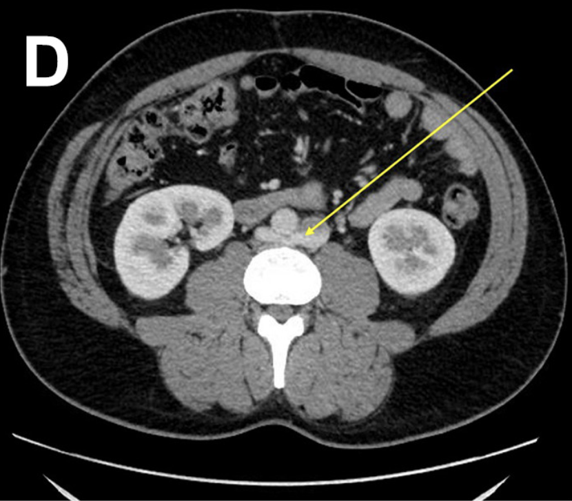 JVS - Venous and Lymphatic Disorders tweet media