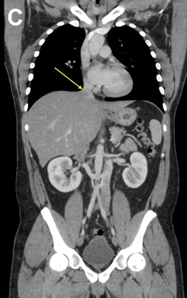 JVS - Venous and Lymphatic Disorders tweet media