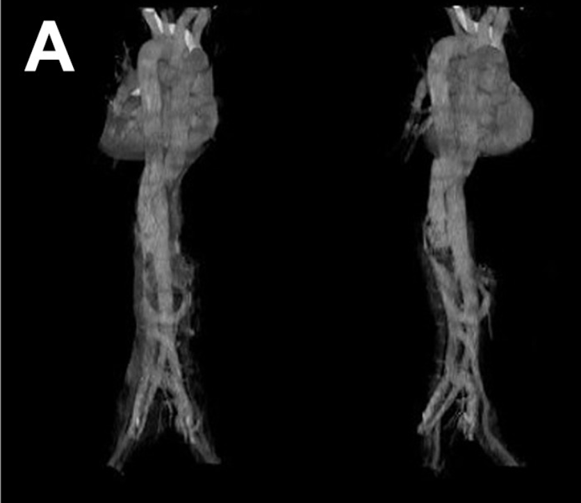 JVS - Venous and Lymphatic Disorders tweet media