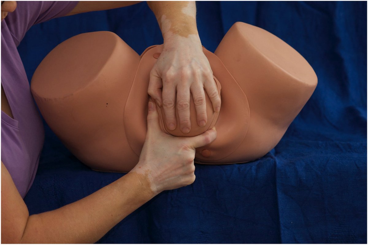 AJOG_thegray's tweet photo. Obstetric anal sphincter injuries in spontaneous vaginal births in nulliparous pregnant individuals: a 21-year cohort study based on real-world data -  protecting the perineum and the other hand controlling the expulsion speed of the baby’s head  https://t.co/9cfGaUfrlm https://t.co/YLNel9pnVE