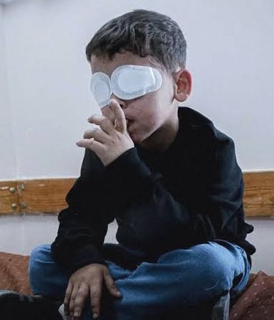Gaza Center for Human Rights:
1,700 Palestinians have lost their eyesight over the past 25 months, while another 5,000 are at risk of losing it due to deprivation of medical treatment. The center holds the Israeli occupation army responsible for causing permanent disabilities