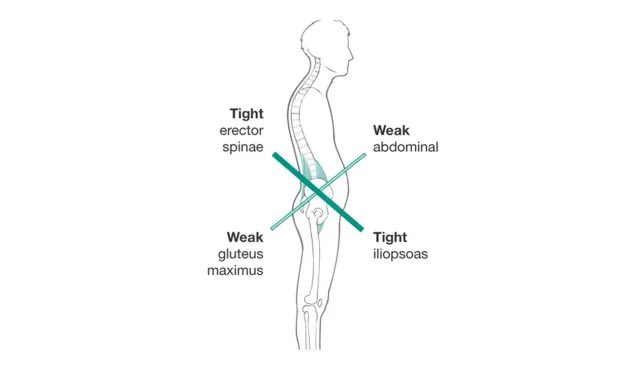 lilJnotcute's tweet image. อันนี้เรียกว่า lower cross body syndrome ได้นะคับ ถ้าเราหลัง+ขาหน้าตึง แต่กล้ามเนื้อท้องไม่แข็งแรงก็จะเป็นแบบในรูปเลย นานๆไปปวดหลังได้(มาก🥹) แนะนำออกกำลังกายพวก core stability กับยืดหลัง+ขาเป็นประจำคับบ