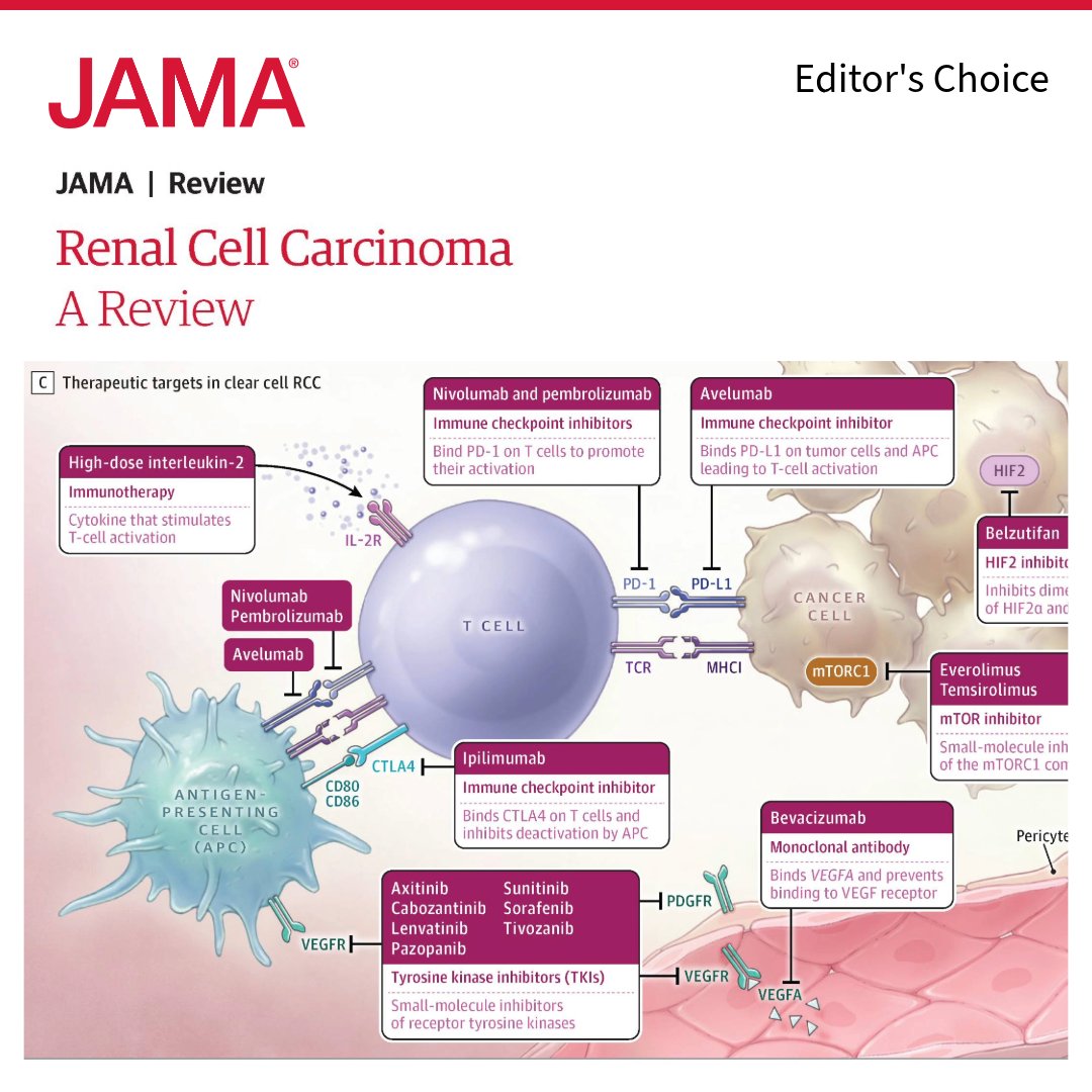 ✅ Editor’s Choice: This Review summarizes the epidemiology, clinical presentation, pathophysiology, and management of renal cell #carcinoma (RCC). In 2023, there were an estimated 81 800 newly diagnosed cases of RCC in the US.

💾 Save this Review for your citations: