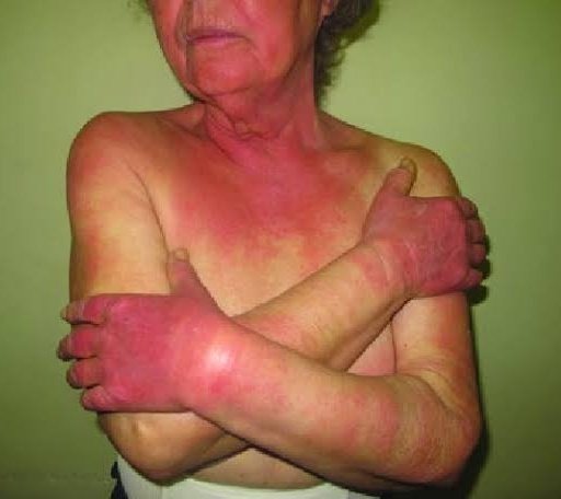 Seen after exposure to sunlight. Which antibiotic causes this❓

A. Amoxicillin
B. Ciprofloxacin
C. Doxycycline
D. Metronidazole
