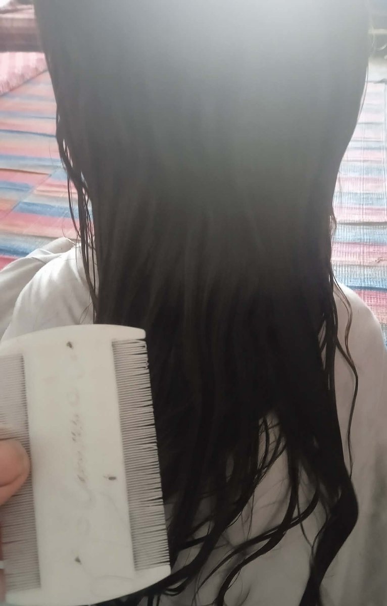 DalulainGaza's tweet image. 😥My poor daughter's hair has become infested with lice due to a lack of water and cleaning supplies. Please help me before my daughter is harmed by these insects. I beg you, I don't want anything bad to happen to her. Please. 
🙏🙏💔
chuffed.org/project/138194…