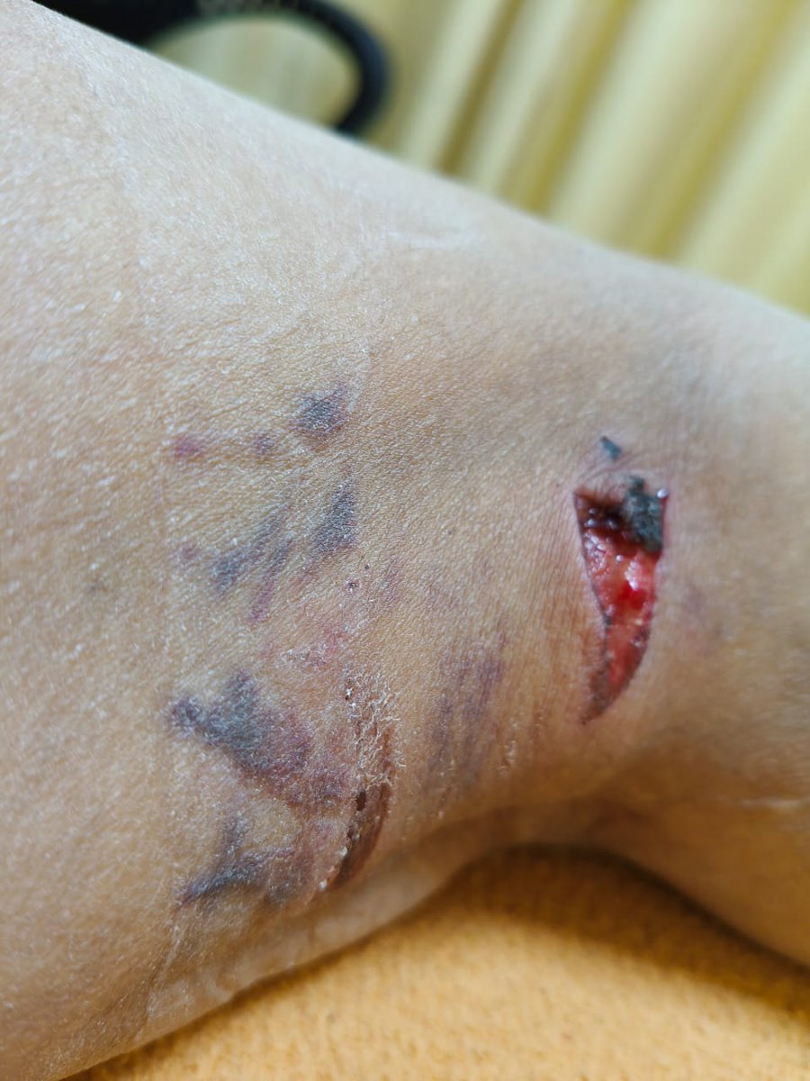 singh_ratna's tweet photo. Multiple incidents of Dog bite in La residentia Greater Noida west ..Immediate attention needed for removal of stray https://t.co/rg9sSfNGPr has became life threatening @indSupremeCourt @h3892938 @dmgbnagar @myogiadityanath @PMOIndia @CeoNoida @SHObisrakh https://t.co/ryxyBTmjgf