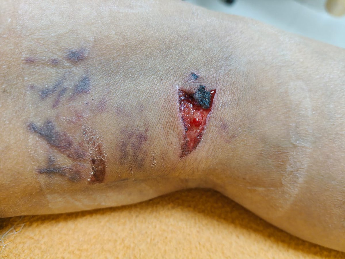 singh_ratna's tweet photo. Multiple incidents of Dog bite in La residentia Greater Noida west ..Immediate attention needed for removal of stray https://t.co/rg9sSfNGPr has became life threatening @indSupremeCourt @h3892938 @dmgbnagar @myogiadityanath @PMOIndia @CeoNoida @SHObisrakh https://t.co/ryxyBTmjgf