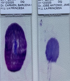 pepeheffernan's tweet image. CC380. Two recent FNAs of large lymph nodes. Both are women with no relevant history
A. Left, supraclavicular
B. Right, axillary
One is a lymphoma. Answer the test below. This nice paper by Elena Vigliar may be of help  doi.org/10.1111/cyt.13… @DrBMcGinn