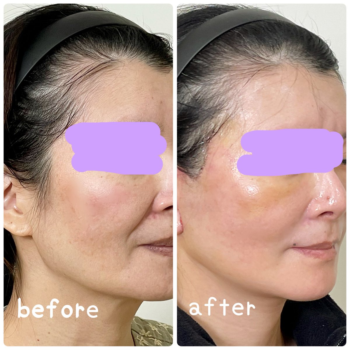 kiko 切開リフトDT中 tweet media