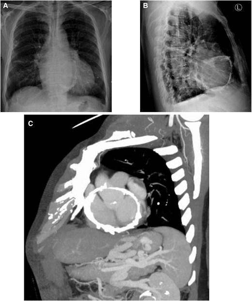 ESC_Journals's tweet photo. 67/M p/w recurrent chest pain and generalised edema. CXR and #whyCT as shown. What is your ddx? https://t.co/W9bKmpDjf4
#EHJCaseReports @Phiso_de @TJ_Yeo @aayshacader @BoldiKovacsMD @SukritiBanthiya @ANazmiCalik @O_Azizy_MD @saramoscatelli7 @EHJCREiC #CardioX https://t.co/FJj4lmX7Cq