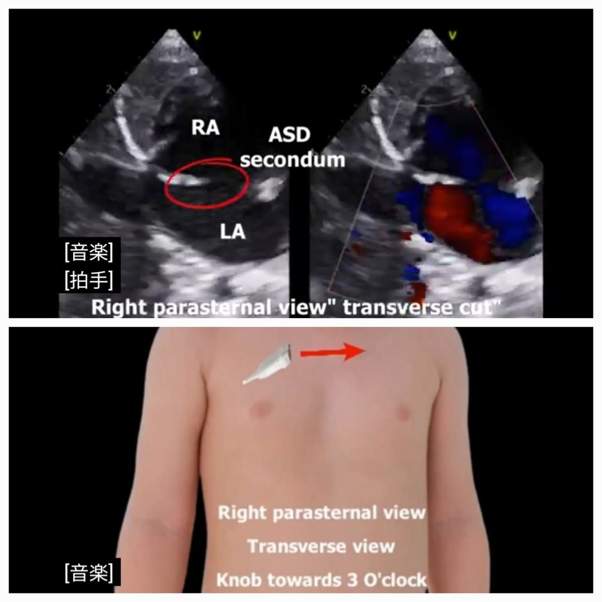 Ahmedata7777's tweet photo. Different Right Parasternal Echo Views

》To assess structures such as:

●Ascending aorta and aortic root

●Superior & inferior vena cavae

●Right atrial anatomy and atrial septum

It can be particularly useful when standard left parasternal views do not provide adequate imaging, such as in evaluation of aortic stenosis or aortic dilatation. 

》Patient Position

Typically lies in right lateral decubitus (turned onto their right side) — this brings the heart closer to the right chest wall. 

https://t.co/FmPHmQxlPg