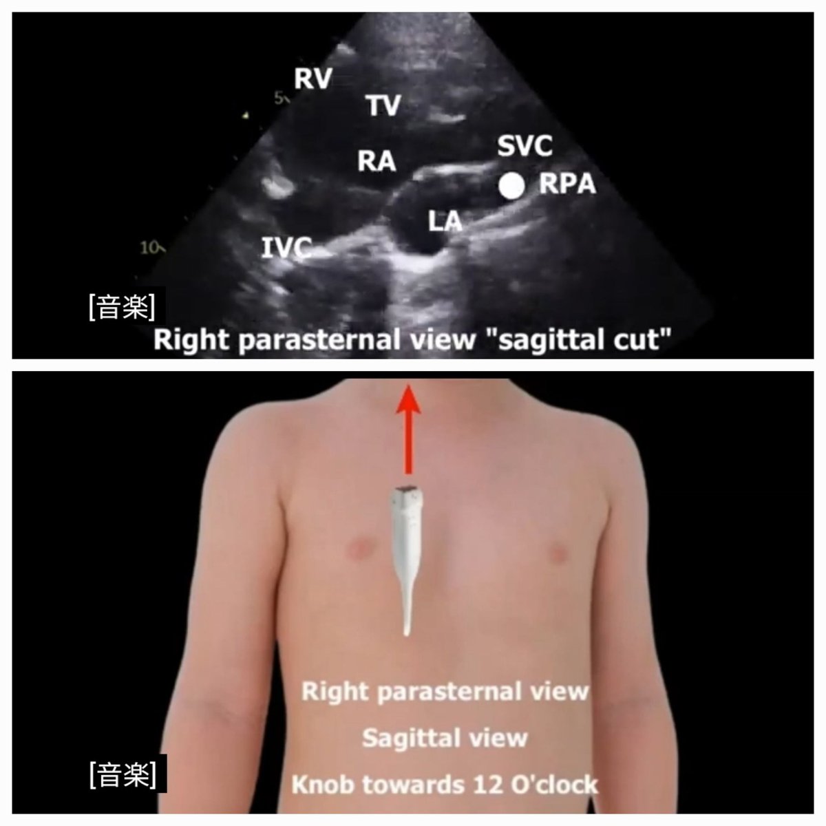 Ahmedata7777's tweet photo. Different Right Parasternal Echo Views

》To assess structures such as:

●Ascending aorta and aortic root

●Superior & inferior vena cavae

●Right atrial anatomy and atrial septum

It can be particularly useful when standard left parasternal views do not provide adequate imaging, such as in evaluation of aortic stenosis or aortic dilatation. 

》Patient Position

Typically lies in right lateral decubitus (turned onto their right side) — this brings the heart closer to the right chest wall. 

https://t.co/FmPHmQxlPg