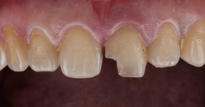 ShareDentalCare's tweet image. Cavities in front teeth don’t just affect dental health, they affect your smile 🦷Early treatment can stop decay, protect enamel, and keep your natural tooth looking healthy.

sharedentalcare.com/tooth-decay-in… 

#ToothDecay #FrontTeeth #DentalCare #OralHealth 😊