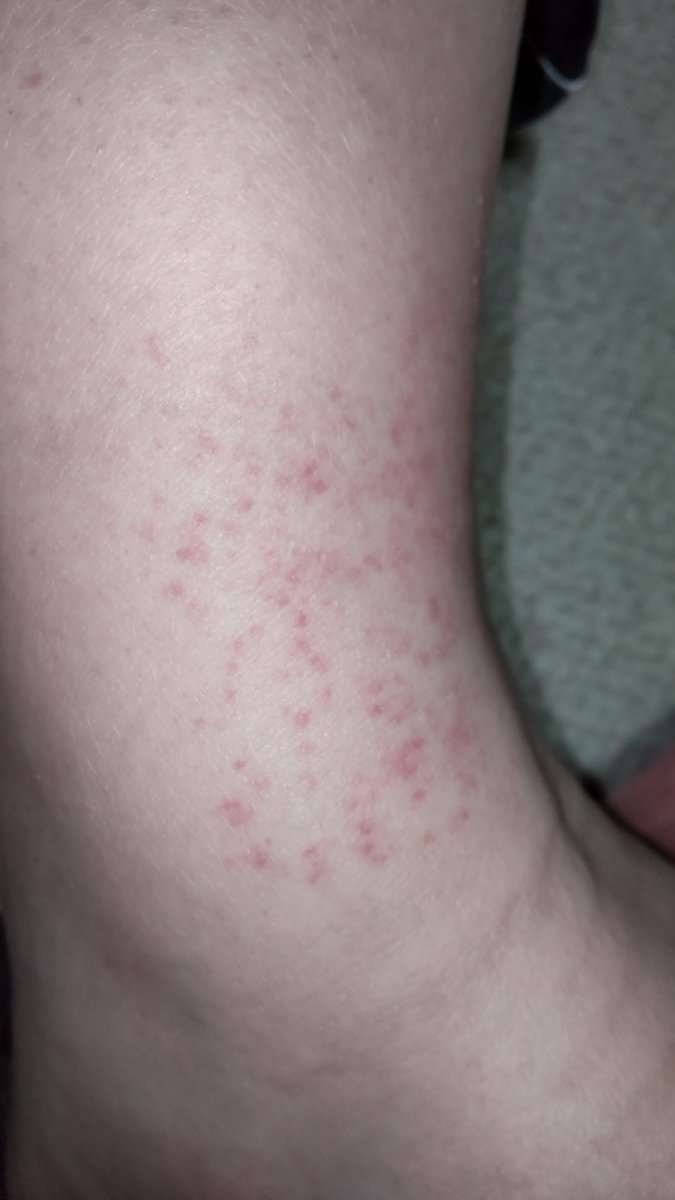 なんだろう？足になんか発疹ではないけど内側に赤い点々。　#足　#赤い点々　#発疹　#医療　#病気　#誰か　#病院