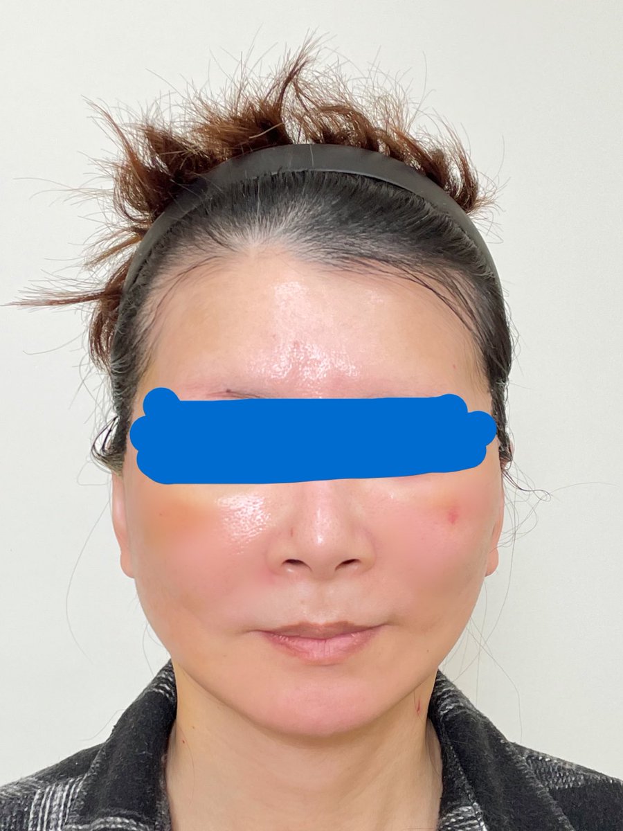 kiko 切開リフトDT中 tweet media