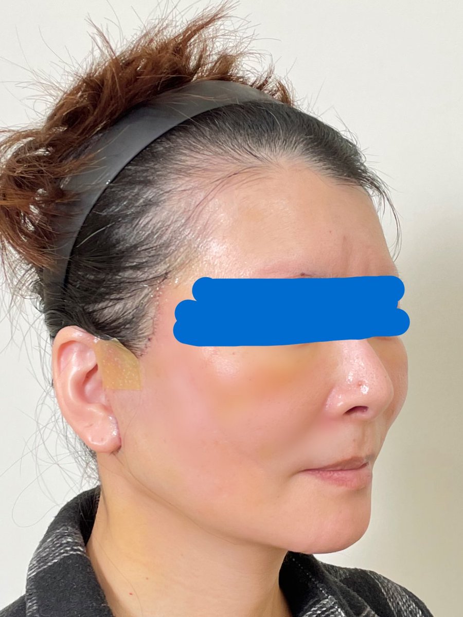 kiko 切開リフトDT中 tweet media