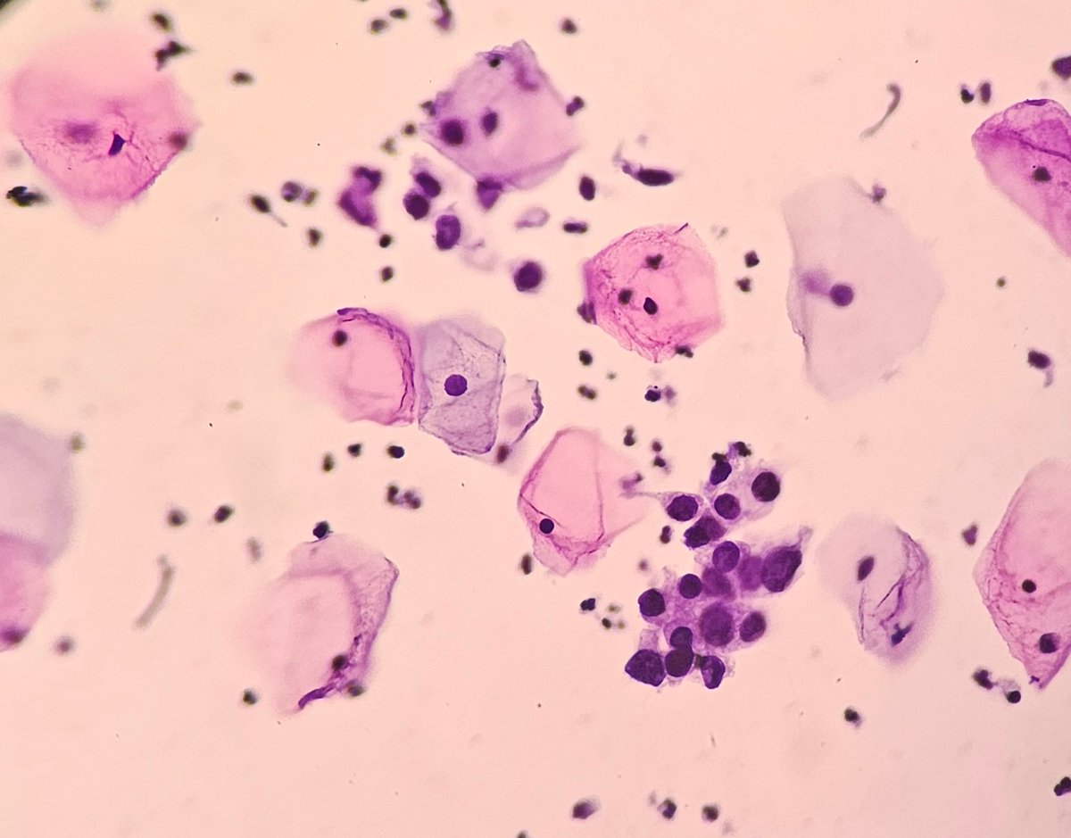 49/F Pap smear #cytopath #PathTwitter #pathresidents #Pap