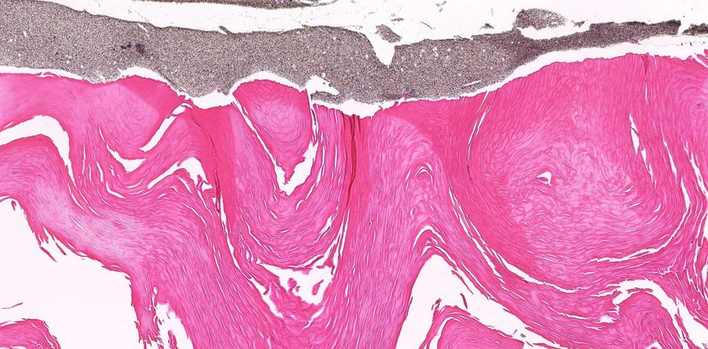 Can you figure out...Site/specimen type? Diagnosis? Fun bonus finding? 
Answer ✅ youtu.be/H9oqFb0X3-E?si…
Digital slide: kikoxp.com/posts/1930. Stains: kikoxp.com/posts/10167. 
#pathology #pathologists #pathTwitter #dermpath #dermatology #dermatologia #dermtwitter