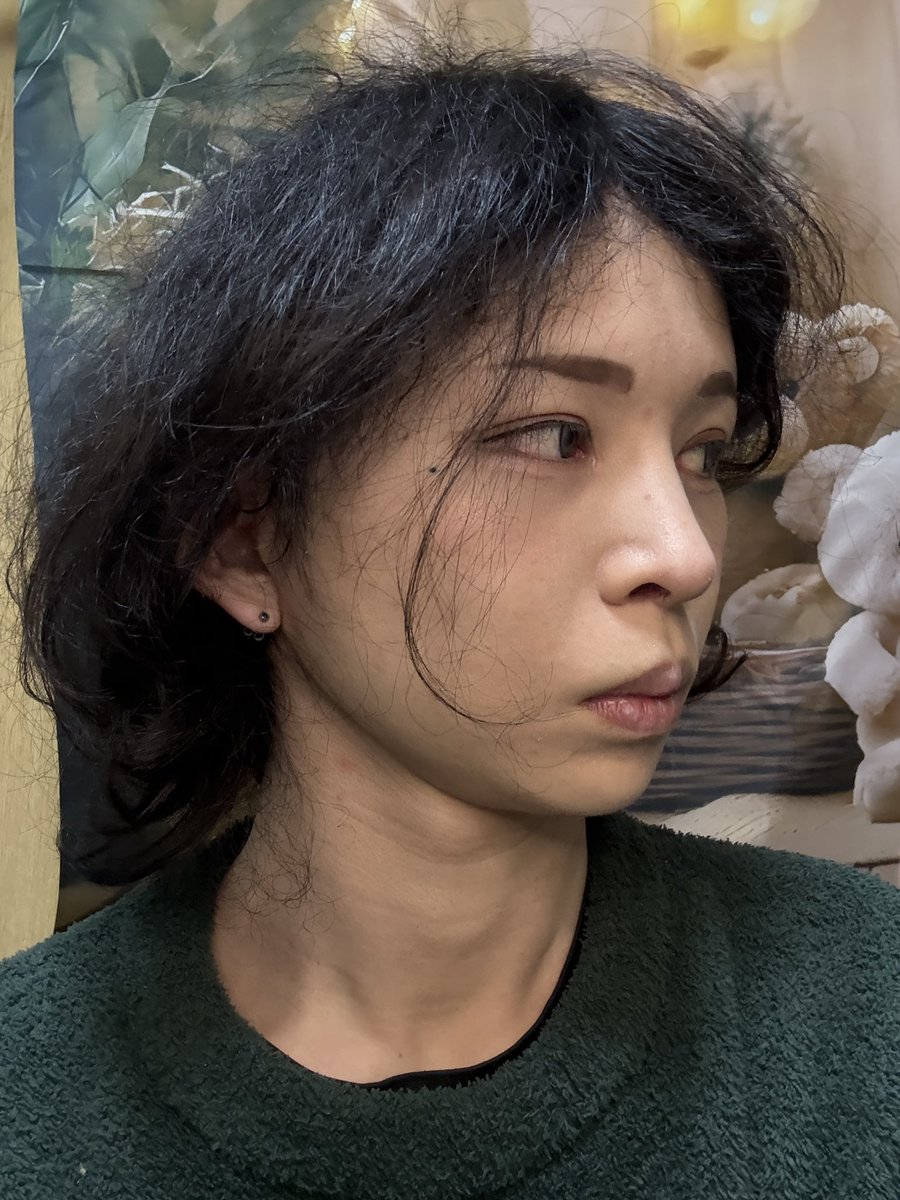 hikaripanic's tweet photo. 2ヶ月目 フル切開リフト・ペリカン

まだ両頬感覚鈍い。見た目では腫れてる感じは見えないが未だに張ってる感じがある��
もう少しシュッとすると思う。

#LIMO美容整形外科  #切開リフト #フル切開リフト #ペリカン手術 https://t.co/I4MNLftiu5