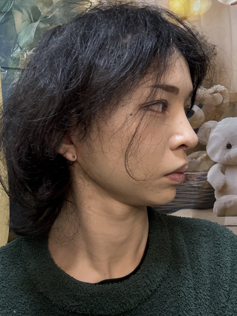hikaripanic's tweet photo. 2ヶ月目 フル切開リフト・ペリカン

まだ両頬感覚鈍い。見た目では腫れてる感じは見えないが未だに張ってる感じがある��
もう少しシュッとすると思う。

#LIMO美容整形外科  #切開リフト #フル切開リフト #ペリカン手術 https://t.co/I4MNLftiu5
