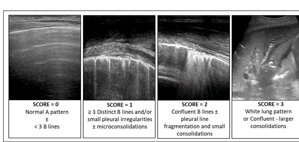🫁▪️Ultrasonido pulmonar en la evaluación y manejo de pacientes con ventilación mecánica.📜
▪️🫁- El protocolo BLUE identifica condiciones pulmonares en el 90% de los casos.  
▪️🫁- Un LUS ≥ 18 indica la necesidad de intubación en pacientes con enfermedades pulmonares