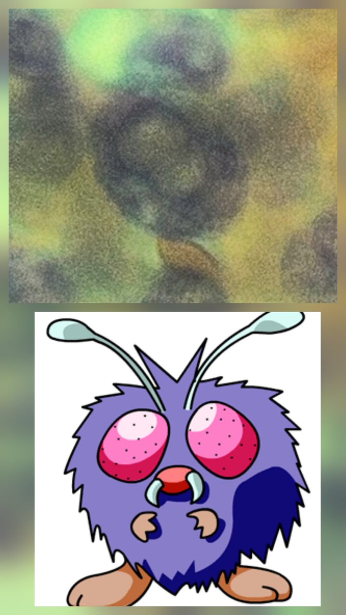 FNA of a papillary thyroid carcinoma showing nuclear pseudoinclusions. Am I crazy or does it really look like Venomat? #cytopathology #pathtwitter #pathology