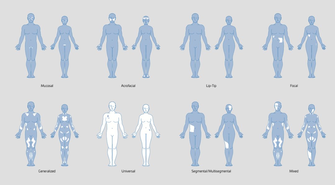 Want to make an OC with vitiligo? Awesome! Vitiligo, while appearing to be random, forms in "types". These determine how and where the vitiligo forms, here is a visual example of the different types. Notice how most of them tend to be symmetrical! Link in the coments!
