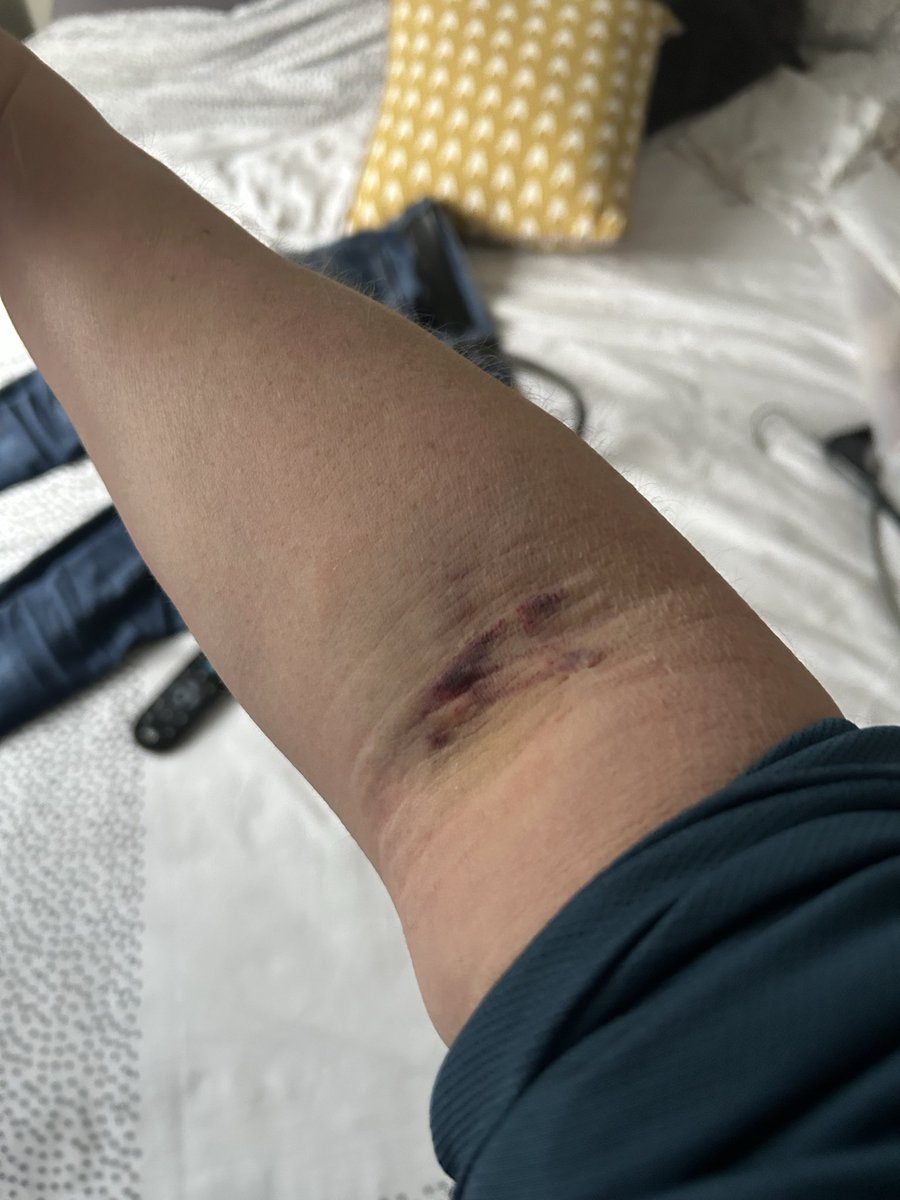 Blood donation went a bit awry….