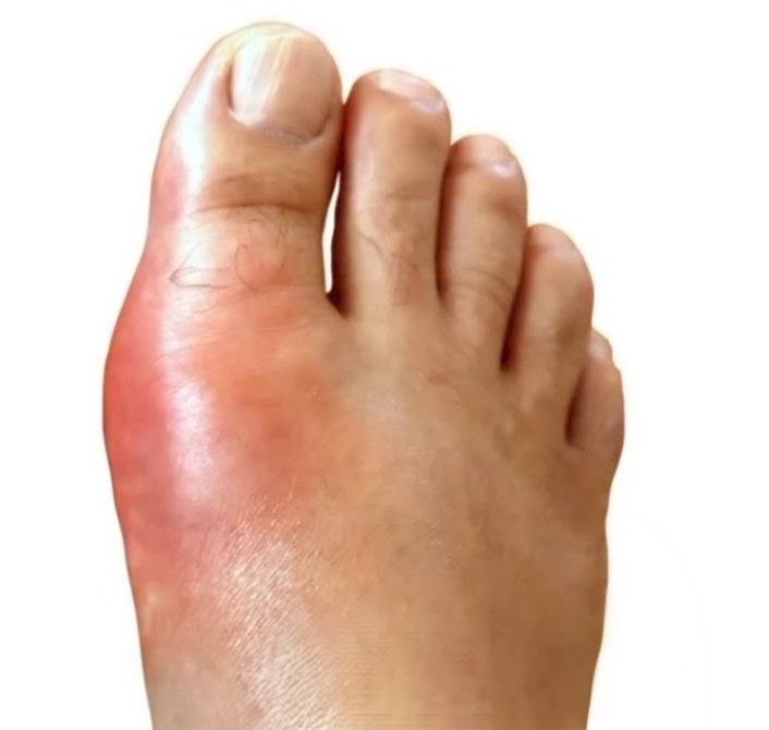 nervemed's tweet photo. Acute Gout is a well-known adverse effect associated with which drug❓

A. Amoxicillin 
B. Levothyroxine
C. Hydrochlorothiazide
D. Diclofenac https://t.co/VmcnoxLmui
