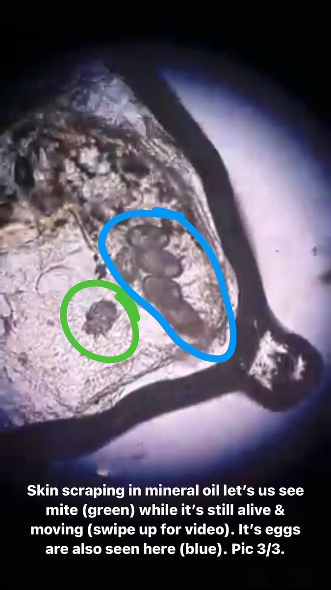 Itchy papules on trunk &amp; webspace. Skin scraping mineral oil prep. 
Answer ✅ youtube.com/shorts/w4NSzqJ… 
#pathology #pathologists #pathTwitter #dermpath #dermatology #dermatologia #dermtwitter