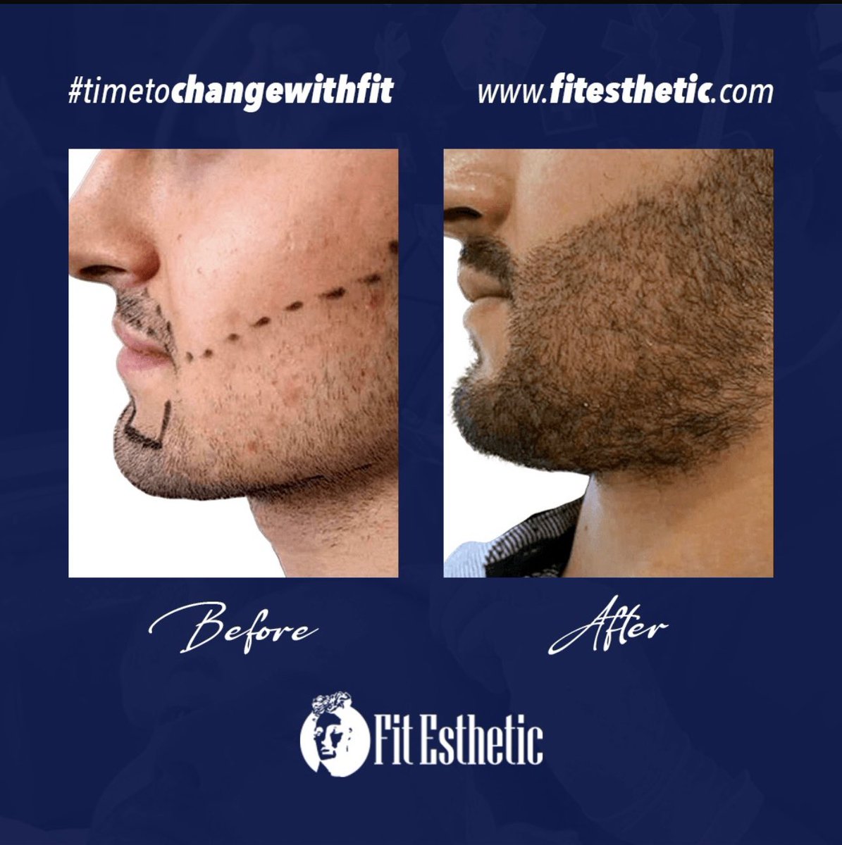 Fit_Esthetic's tweet photo. Beard transplantation is a procedure that requires professional anatomical knowledge.
Since the facial nerves are very close to the surface, it should be performed by healthcare professionals with qualified medical expertise.
#Saçekimi
#Sakalekimi
#Hairtransplant
#Beardtransplant https://t.co/BkeqrvzbyL
