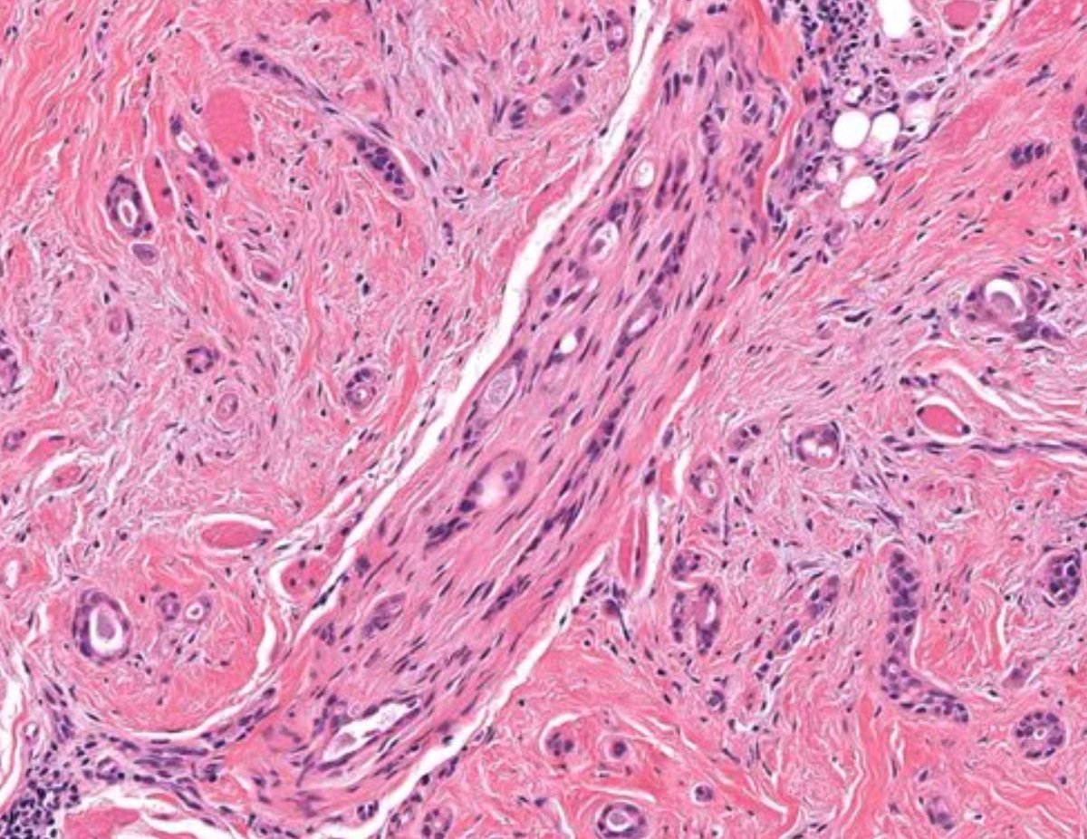 60 F. Scar-like cheek plaque. Diagnosis? 
Digital slide: kikoxp.com/posts/6992
Answer ✅ youtu.be/omdqVEm3qfk
Handout, images, &amp; differential: kikoxp.com/posts/8378. 
#pathology #pathologists #pathTwitter #dermpath #dermatology #dermatologia #dermtwitter