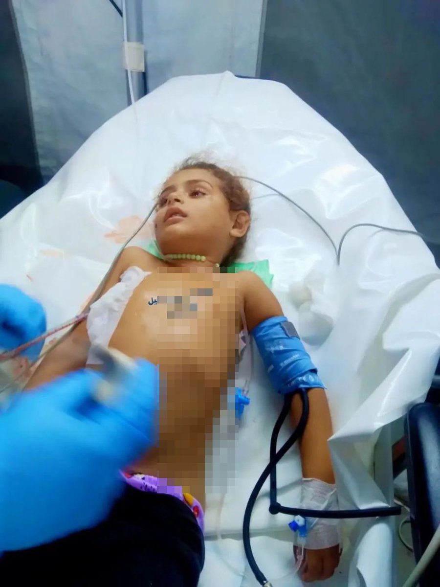 MosabAbuToha's tweet image. A five-year-old child, Jenan Abu Amrah, was m shot by an Israeli terrorist naval gunboat while on a beach in southern Gaza near her family tent. She is currently receiving treatment at the Red Cross field hospital.