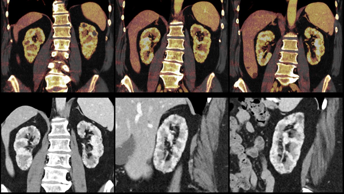 danatsouza's tweet photo. 69-year-old female patient presenting with worsening renal function... CT and MRI images provided.

What is the medication that is causing this? GIFs only please!

@BrighamRad @FOAMrad @SAR_RFS @futureradres @ARRS_Radiology @Abdominal_Rad @CBRadiologia #MedEd https://t.co/7dJFUHfiGa